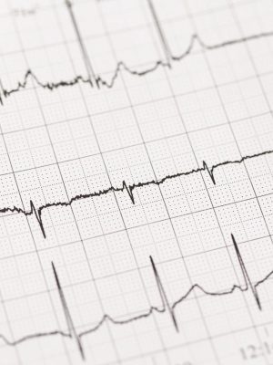 Close up of ECG, electrocardiogram. The work of a healthy heart on paper.